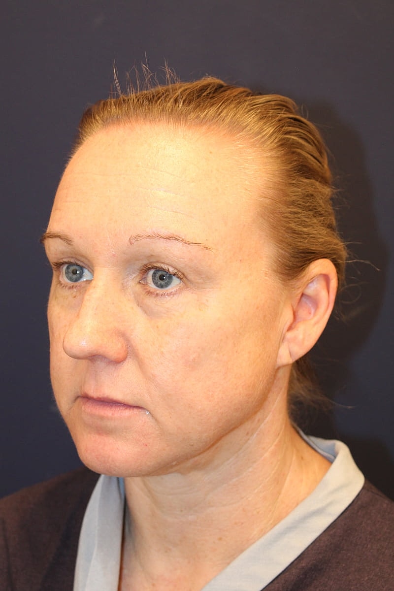 Neck Liposuction Gallery Before & After