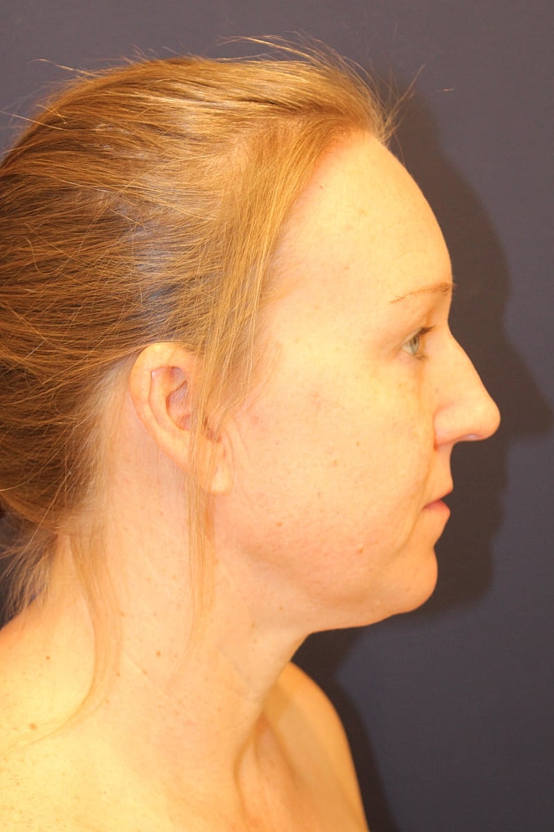 Neck Liposuction Gallery Before & After