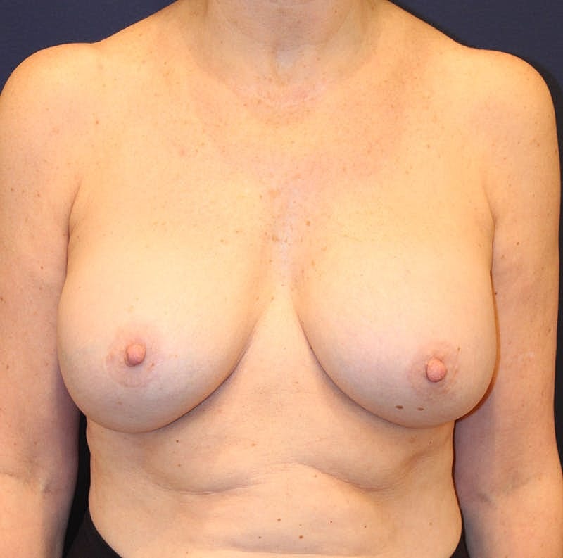 Breast Implant Revision Before & After