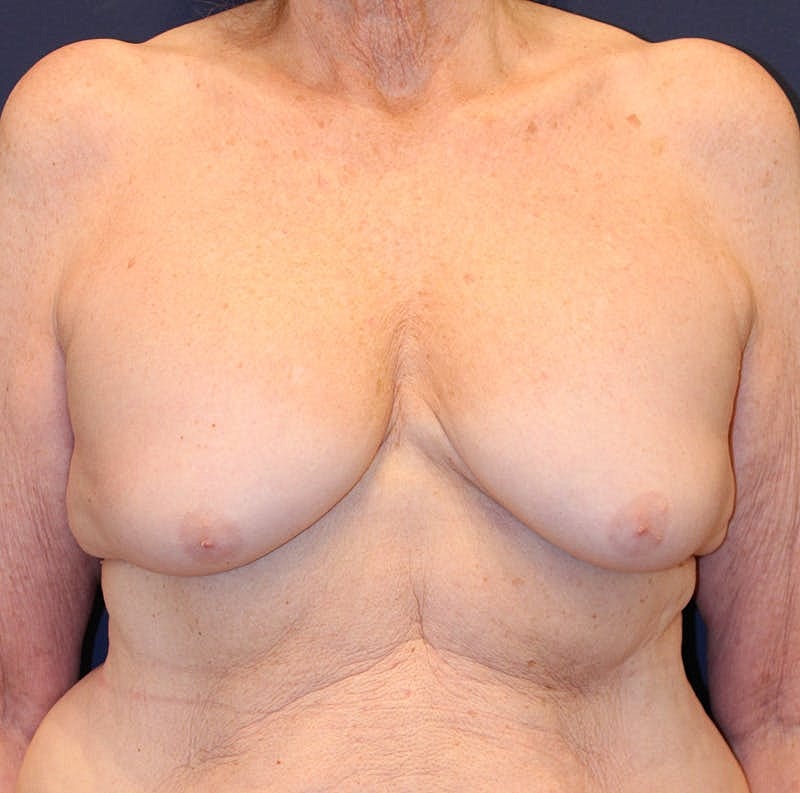 Breast Implant Revision Before & After
