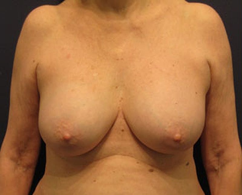 Breast Implant Revision Before & After