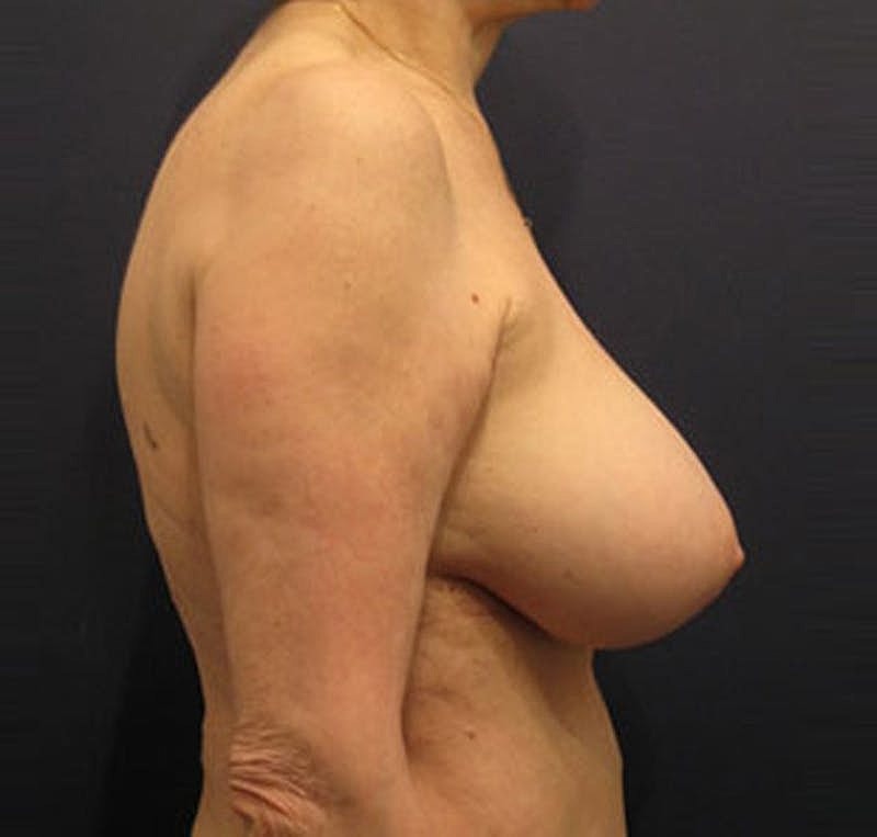 Breast Implant Revision Before & After