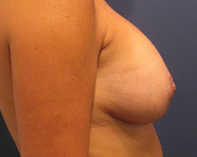 Breast Implant Revision Before & After