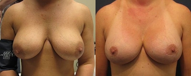 Breast Implant Revision Before & After