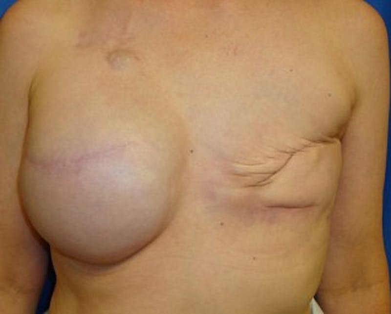 Breast Implant Revision Before & After