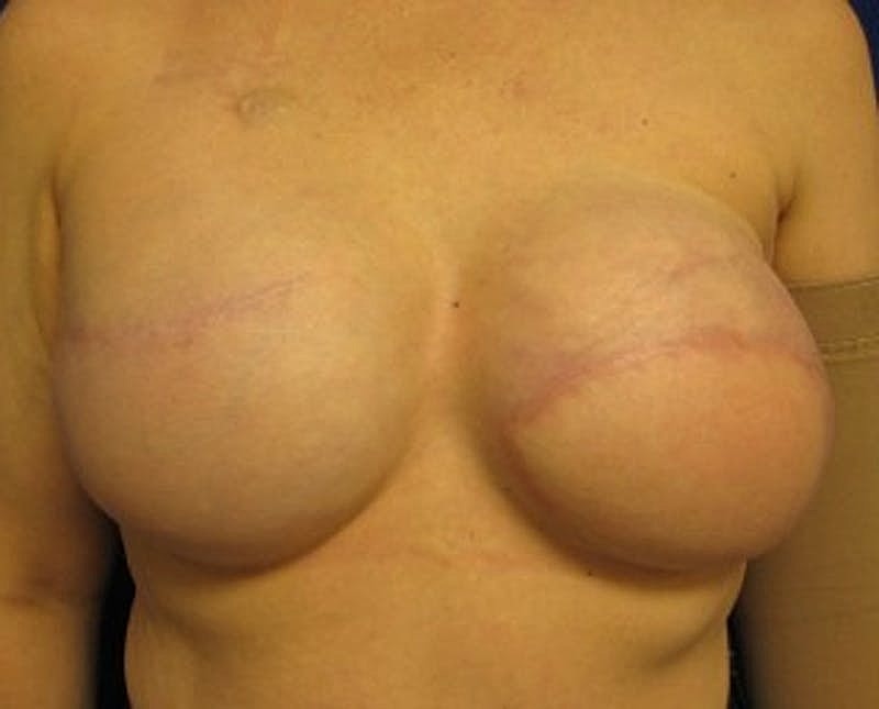 Breast Implant Revision Before & After