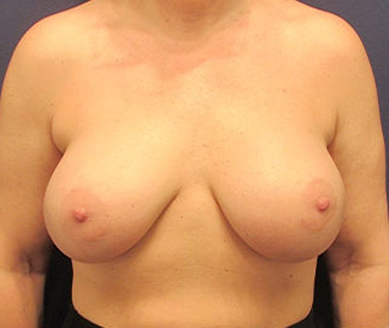 Breast Implant Revision Before & After