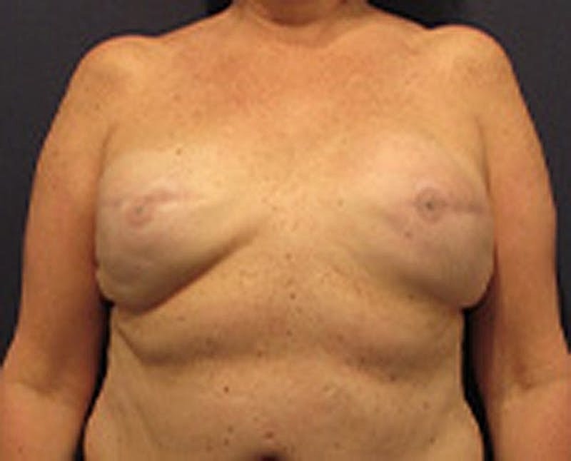 Breast Implant Revision Before & After