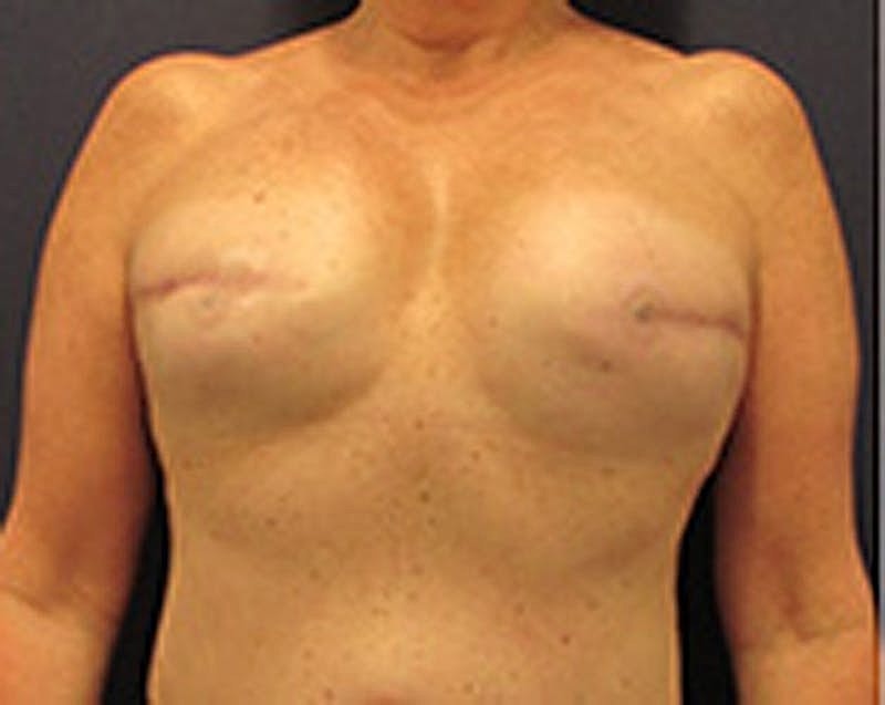 Breast Implant Revision Before & After