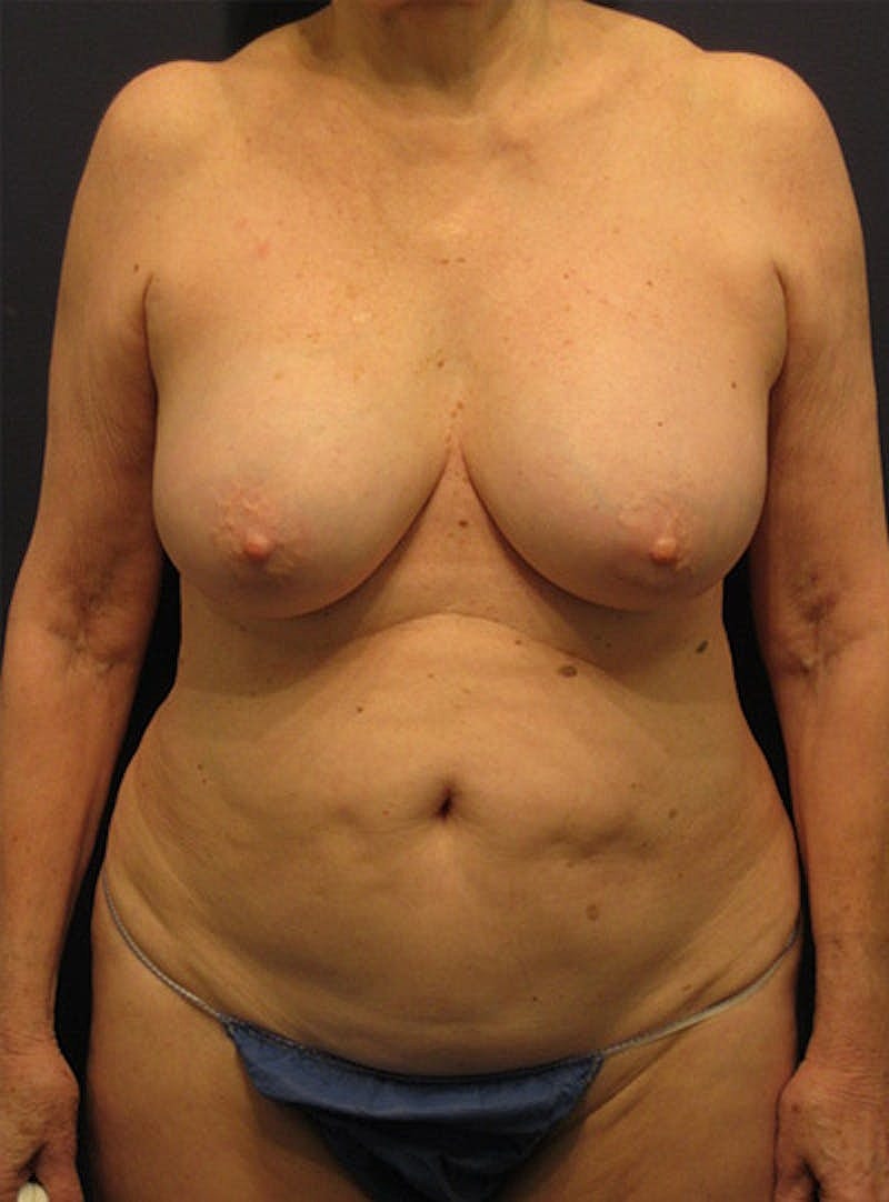 Breast Removal Explant Before & After