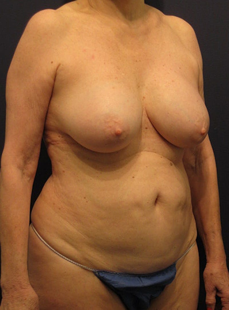 Breast Removal Explant Before & After