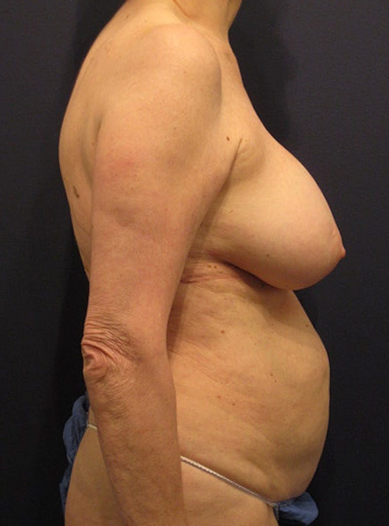 Breast Removal Explant Before & After