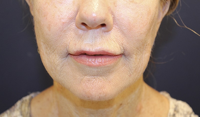 Lip Lift Gallery Before & After